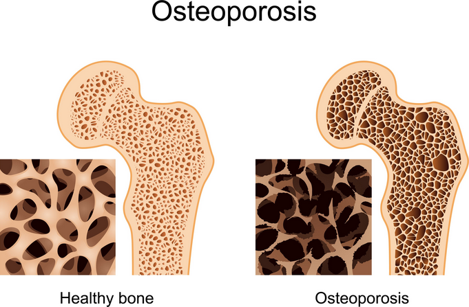 The difference between a healthy bone and an osteoporotic bone